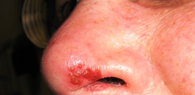 Causas del herpes en la nariz